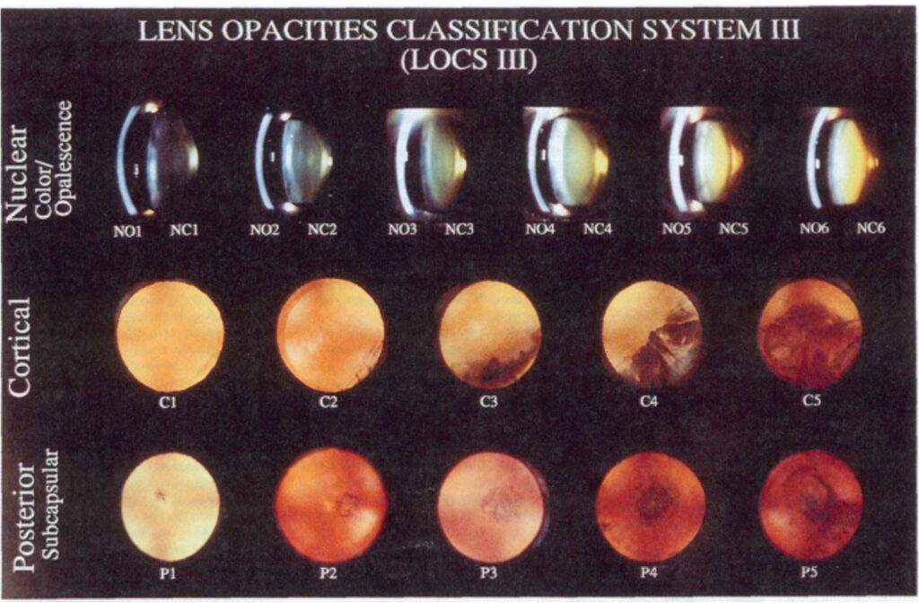 The Lens Opacities Classification System III